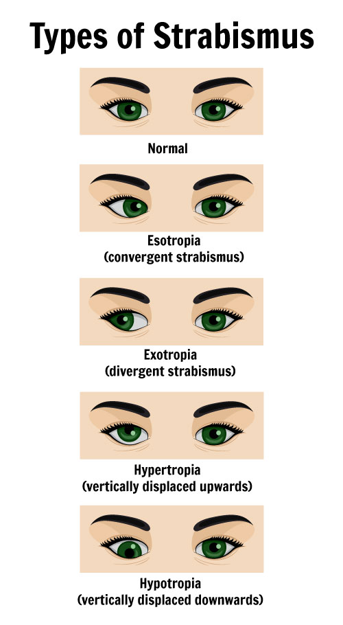 Esotropia (cross-eyed) and its causes and symptoms